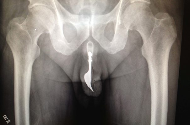 Insolite : Un homme de 70 ans est opéré après s’être inséré une fourchette dans le pénis