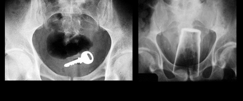 10 objets trop bizarres retrouvés coincés dans un derrière