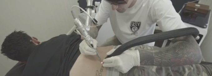 Voyez le processus pour faire enlever un tatouage