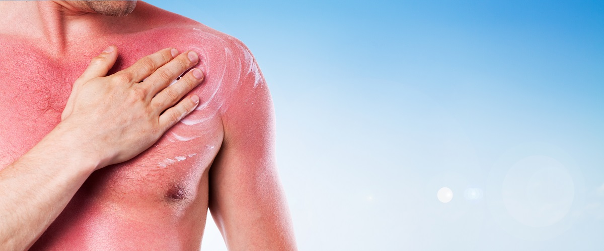 10 raisons de ne jamais mettre de crème solaire, parce que c’est beau la peau rouge