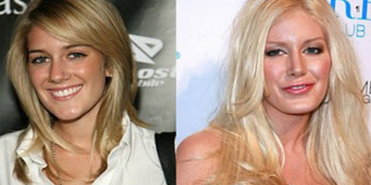 Voici 5 célébrités qui ont absolument gâché leur face par la chirurgie