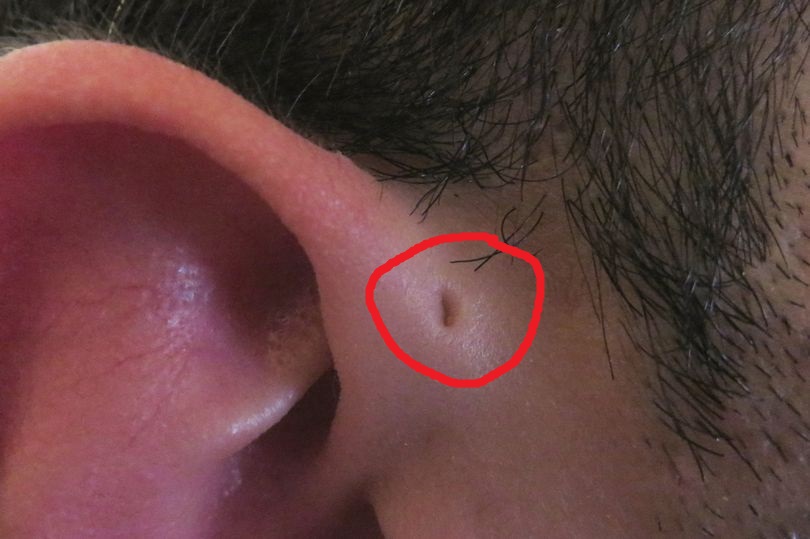 Voici pourquoi certaines personnes ont de petits trous sur les oreilles